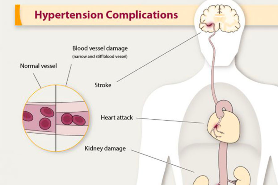 Hypertension Complications